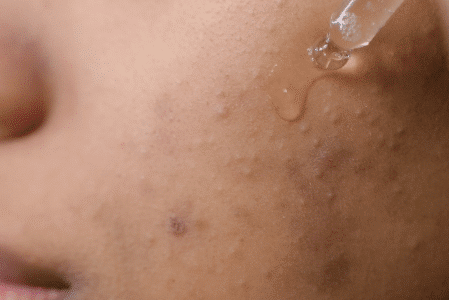 acné hormonale et naturopathie